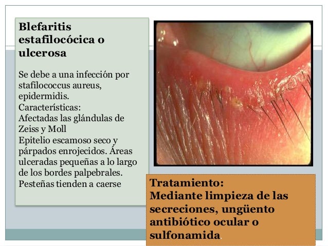 Los ungüentos rusos de la psoriasis la lista
