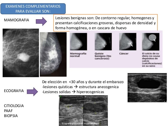 patologia benigna y maligna de mama