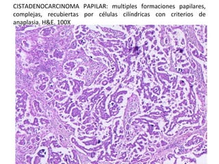 CISTADENOCARCINOMA PAPILAR: multiples formaciones papilares,
complejas, recubiertas por células cilíndricas con criterios de
anaplasia. H&E. 100X

 