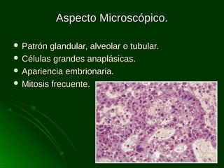 Aspecto Microscópico.
 Patrón

glandular, alveolar o tubular.
 Células grandes anaplásicas.
 Apariencia embrionaria.
 Mitosis frecuente.

 