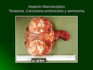 Aspecto Macroscópico.
Teratoma, Carcinoma embrionario y seminoma.

 