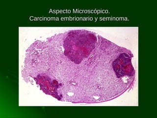 Aspecto Microscópico.
Carcinoma embrionario y seminoma.

 