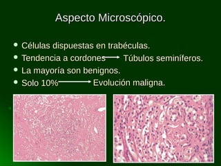 Aspecto Microscópico.
 Células

dispuestas en trabéculas.
 Tendencia a cordones
Túbulos seminíferos.
 La mayoría son benignos.
 Solo 10%
Evolución maligna.

 
