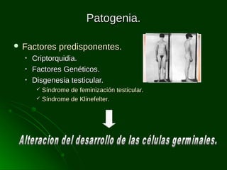 Patogenia.
 Factores
•
•
•

predisponentes.

Criptorquidia.
Factores Genéticos.
Disgenesia testicular.
Síndrome de feminización testicular.
 Síndrome de Klinefelter.


 