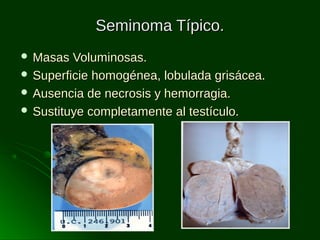 Seminoma Típico.
 Masas

Voluminosas.
 Superficie homogénea, lobulada grisácea.
 Ausencia de necrosis y hemorragia.
 Sustituye completamente al testículo.

 