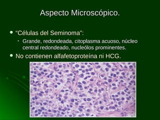Aspecto Microscópico.
 “Células
•

del Seminoma”:

Grande, redondeada, citoplasma acuoso, núcleo
central redondeado, nucleólos prominentes.

 No

contienen alfafetoproteína ni HCG.

 