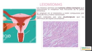 Pyomyoma Comprehensive Ultrasonographic Approach to Uterine Pathology ...