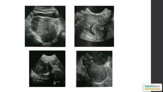 Pyomyoma Comprehensive Ultrasonographic Approach to Uterine Pathology ...