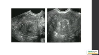 Pyomyoma Comprehensive Ultrasonographic Approach to Uterine Pathology ...