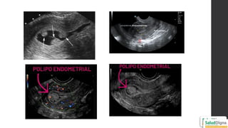 Pyomyoma Comprehensive Ultrasonographic Approach to Uterine Pathology ...