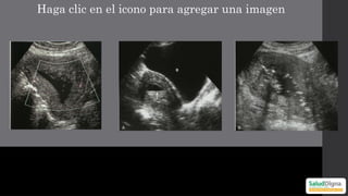 Pyomyoma Comprehensive Ultrasonographic Approach to Uterine Pathology ...
