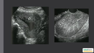 Pyomyoma Comprehensive Ultrasonographic Approach to Uterine Pathology ...