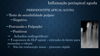 Inflamação periapical aguda
PERIODONTITE APICAL AGUDA
Negativo
Teste de sensibilidade pulpar:
Positivos
Percussão e Palpação:
 Achados radiográficos:
 espessura do ELP apical – extrusão do dente para
acomodar o edema
 Não há reabsorção óssea – processo rápido
 