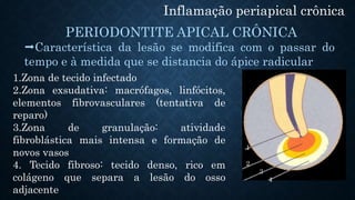 Inflamação periapical crônica
PERIODONTITE APICAL CRÔNICA
1.Zona de tecido infectado
2.Zona exsudativa: macrófagos, linfócitos,
elementos fibrovasculares (tentativa de
reparo)
3.Zona de granulação: atividade
fibroblástica mais intensa e formação de
novos vasos
4. Tecido fibroso: tecido denso, rico em
colágeno que separa a lesão do osso
adjacente
Característica da lesão se modifica com o passar do
tempo e à medida que se distancia do ápice radicular
1
2
3
4
 