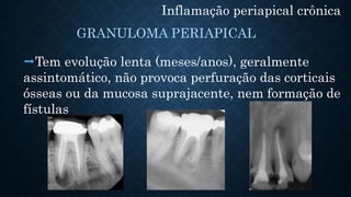 Inflamação periapical crônica
Tem evolução lenta (meses/anos), geralmente
assintomático, não provoca perfuração das corticais
ósseas ou da mucosa suprajacente, nem formação de
fístulas
GRANULOMA PERIAPICAL
 