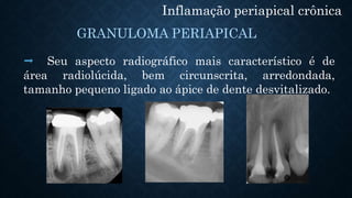 Inflamação periapical crônica
 Seu aspecto radiográfico mais característico é de
área radiolúcida, bem circunscrita, arredondada,
tamanho pequeno ligado ao ápice de dente desvitalizado.
GRANULOMA PERIAPICAL
 