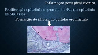 Inflamação periapical crônica
Proliferação epitelial no granuloma -Restos epiteliais
de Malassez
Formação de ilhotas de epitélio organizado
 