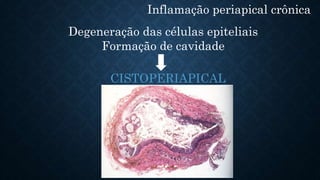Inflamação periapical crônica
Degeneração das células epiteliais
Formação de cavidade
CISTOPERIAPICAL
 