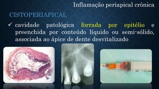 Inflamação periapical crônica
 cavidade patológica forrada por epitélio e
preenchida por conteúdo líquido ou semi-sólido,
associada ao ápice de dente desvitalizado
CISTOPERIAPICAL
 