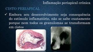Inflamação periapical crônica
 Embora seu desenvolvimento seja consequência
do estímulo inflamatório, não se sabe exatamente
porque nem todos os granulomas se transformam
em cistos
CISTO PERIAPICAL
 