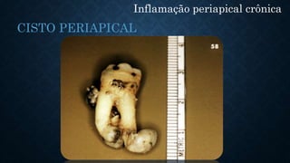 Inflamação periapical crônica
CISTO PERIAPICAL
 