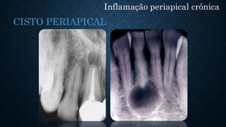 Inflamação periapical crônica
CISTO PERIAPICAL
 