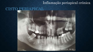 Inflamação periapical crônica
CISTO PERIAPICAL
 