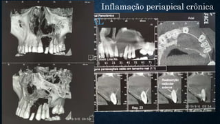 Inflamação periapical crônica
CISTO PERIAPICAL
 
