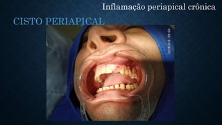 Inflamação periapical crônica
CISTO PERIAPICAL
 