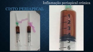 Inflamação periapical crônica
CISTO PERIAPICAL
 