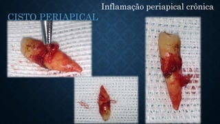 Inflamação periapical crônica
CISTO PERIAPICAL
 