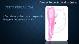 • Se desenvolve por expansão,
lentamente, assintomático
Inflamação periapical crônica
CISTO PERIAPICAL
 