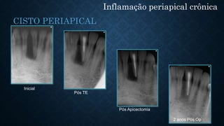 Inflamação periapical crônica
CISTO PERIAPICAL
Pós TE
Inicial
Pós Apicectomia
2 anos Pós Op
 