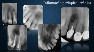 Inflamação periapical crônica
 