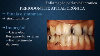 Inflamação periapical crônica
PERIODONTITE APICAL CRÔNICA
 Sinais e sintomas:
 Assintomático
Inspeção:
Cárie e/ou
Restauração extensa
Escurecimento
da coroa
 