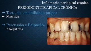 Inflamação periapical crônica
PERIODONTITE APICAL CRÔNICA
 Teste de sensibilidade pulpar:
 Negativo
 Percussão e Palpação:
 Negativos
 