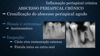 Inflamação periapical crônica
ABSCESSO PERIAPICAL CRÔNICO
 Cronificação do abscesso periapical agudo
 Sinais e sintomas:
 Assintomático
 Inspeção:
 Cárie e/ou restauração extensa
 Fístula intra ou extra oral
 