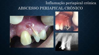 Inflamação periapical crônica
ABSCESSO PERIAPICAL CRÔNICO
 