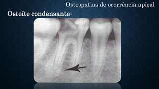 Osteopatias de ocorrência apical
Osteíte condensante:
 