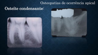 Osteopatias de ocorrência apical
Osteíte condensante:
 
