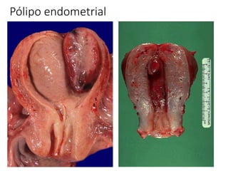 Pólipo endometrial
 