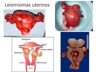Leiomiomas uterinos
 
