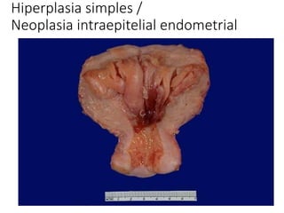 Hiperplasia simples /
Neoplasia intraepitelial endometrial
 