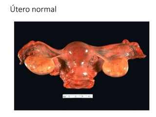 Útero normal
 