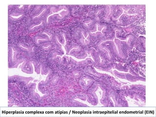 Hiperplasia complexa com atipias / Neoplasia intraepitelial endometrial (EIN)
 
