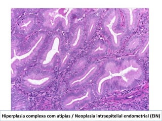 Hiperplasia complexa com atipias / Neoplasia intraepitelial endometrial (EIN)
 