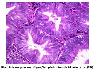 Hiperplasia complexa com atipias / Neoplasia intraepitelial endometrial (EIN)
 