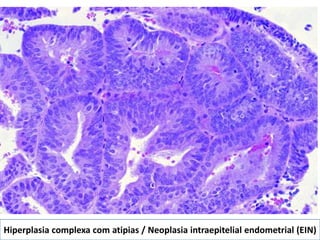 Hiperplasia complexa com atipias / Neoplasia intraepitelial endometrial (EIN)
 