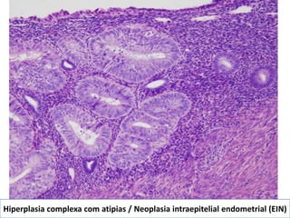 Hiperplasia complexa com atipias / Neoplasia intraepitelial endometrial (EIN)
 