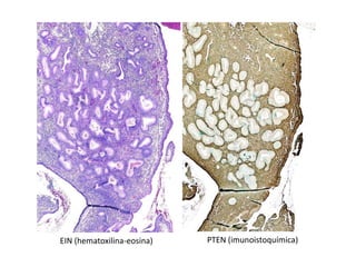 EIN (hematoxilina-eosina) PTEN (imunoistoquímica)
 